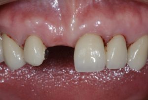 前歯にインプラントの治療を行う前の画像